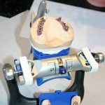 Dental-Arbeiten von RAB Zahntechnik Dentallabor Berlin Dental-Arbeiten von RAB Zahntechnik Dentallabor Berlin