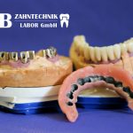 Dental-Arbeiten von RAB Zahntechnik Dentallabor Berlin Dental-Arbeiten von RAB Zahntechnik Dentallabor Berlin