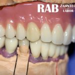 Dental-Arbeiten von RAB Zahntechnik Dentallabor Berlin Dental-Arbeiten von RAB Zahntechnik Dentallabor Berlin